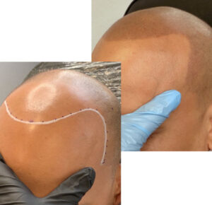 Professional Scalp Micropigmentation services Scottsdale, Arizona